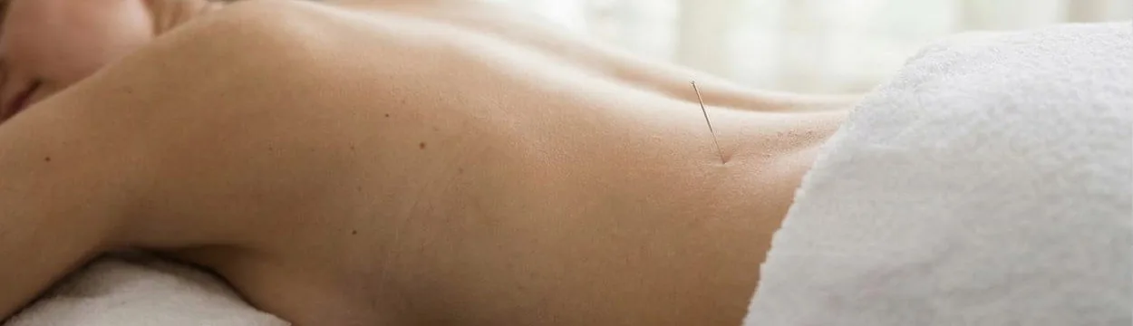 Acupuncture needles placed along the upper back